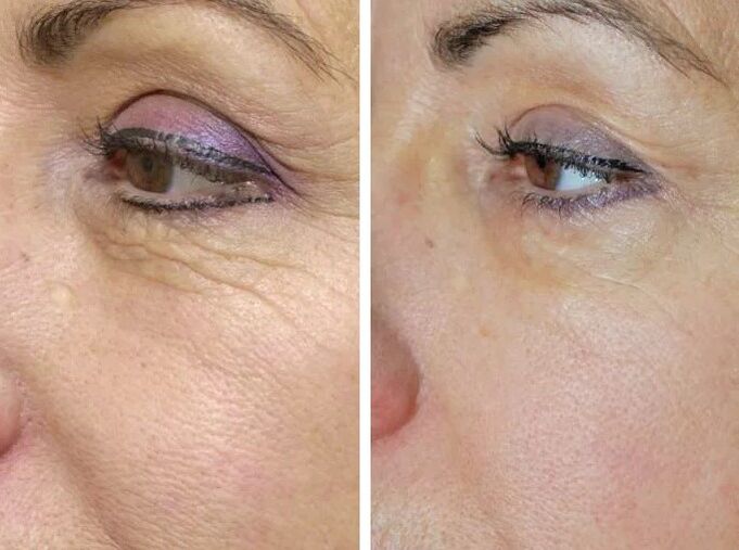 Before and after the field laser