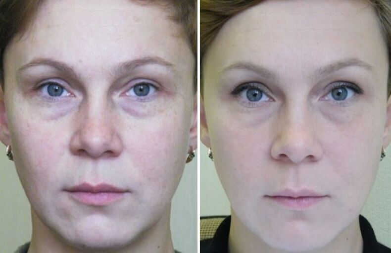 Before and after pictures of laser rejuvenation
